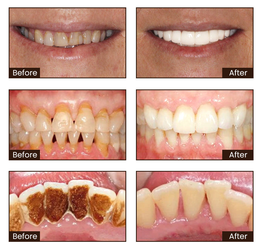 Whitening Toothpaste